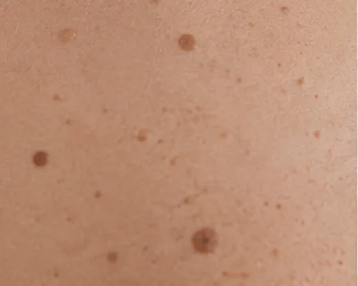 Dermatochirurgie in Rostock – operative Entfernung von Hautveränderungen bei Dr. Dr. Ole Jung